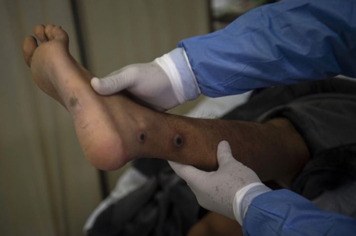 Monkeypox cases top 50,000, says WHO